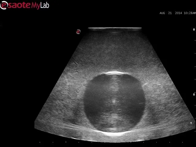 Abscess Drainage Ultrasound Training Model