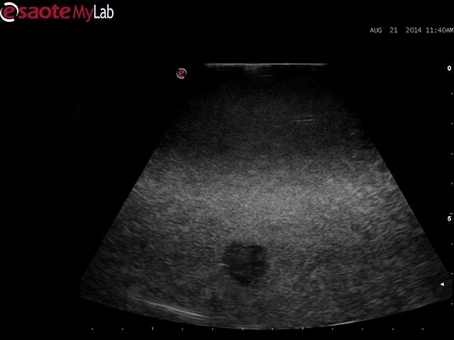 Abscess Drainage Ultrasound Training Model