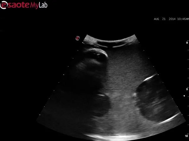 Abscess Drainage Ultrasound Training Model