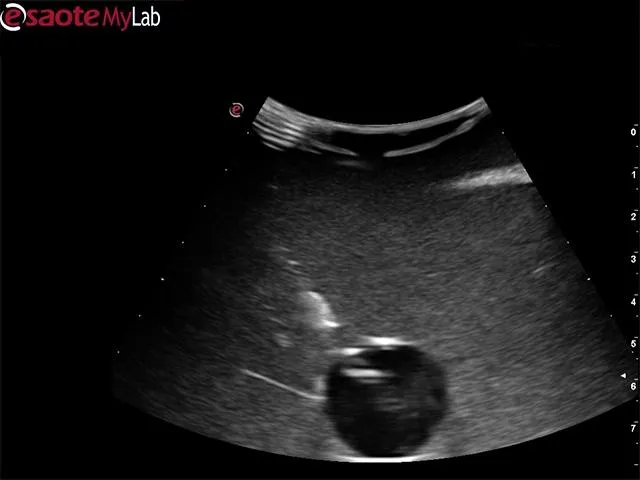 Abscess Drainage Ultrasound Training Model