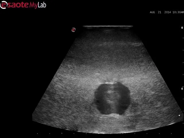 Abscess Drainage Ultrasound Training Model