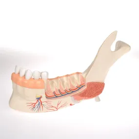 Advanced Half Lower Jaw with 8 Diseased Teeth
