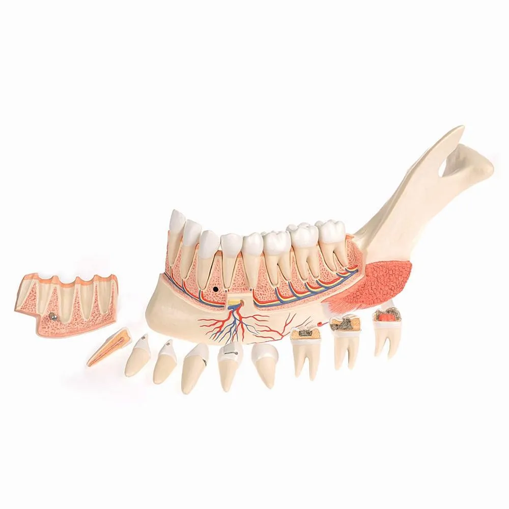 Advanced Half Lower Jaw with 8 Diseased Teeth