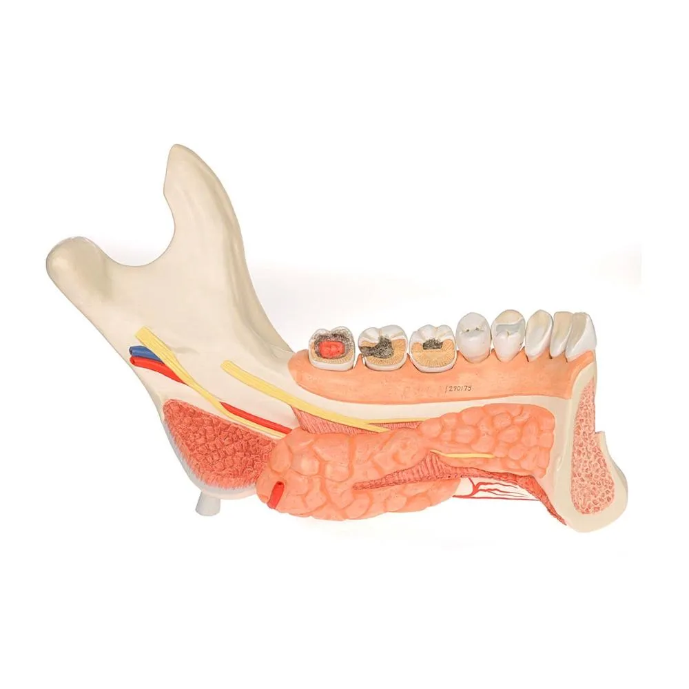Advanced Half Lower Jaw with 8 Diseased Teeth