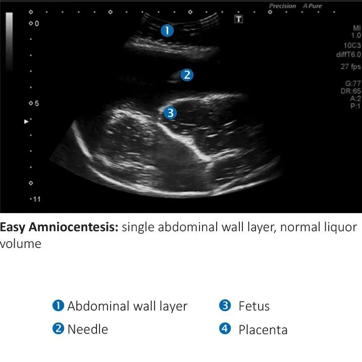 AMNIO ABBY® - Ultrasound Guided Invasive Procedures Simulator