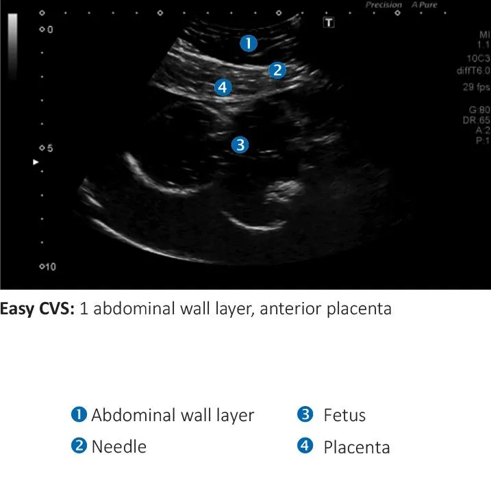 AMNIO ABBY® - Ultrasound Guided Invasive Procedures Simulator