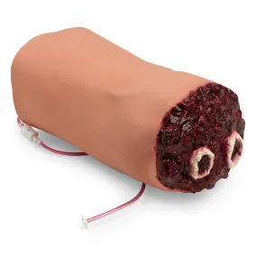 Amputed Arm for SMART STAT