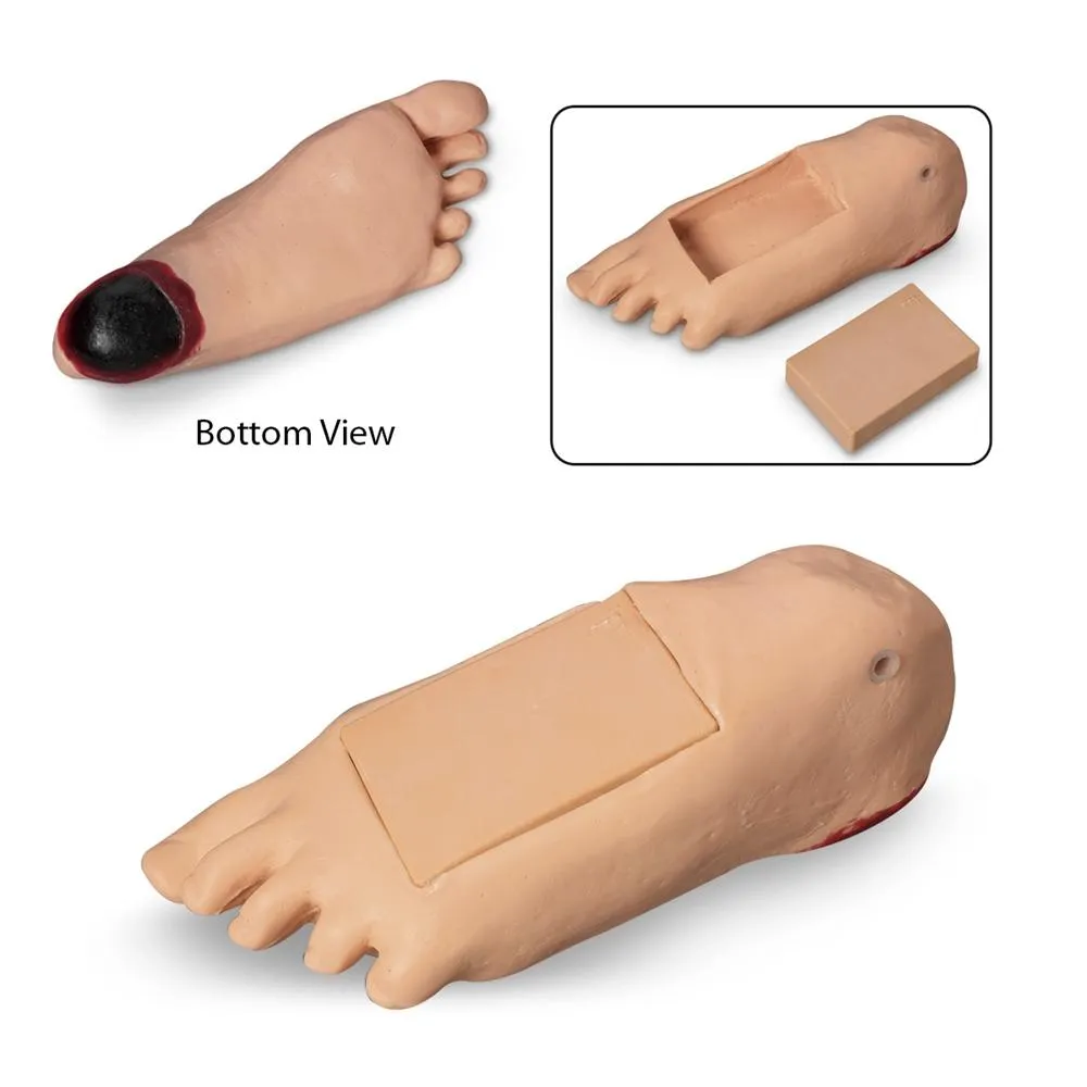 Edema Foot With Tissue Injury for GERi™-KERi™, Light Skin