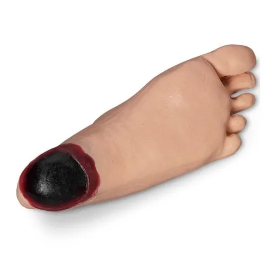 Edema Foot With Tissue Injury for GERi™-KERi™, Light Skin