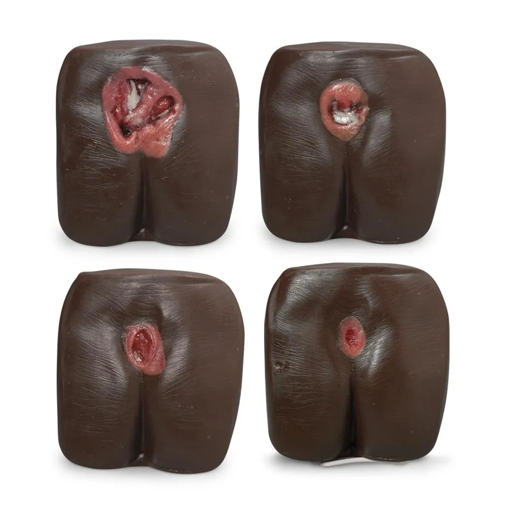 Pressure Ulcer-Bedsore Model, Dark
