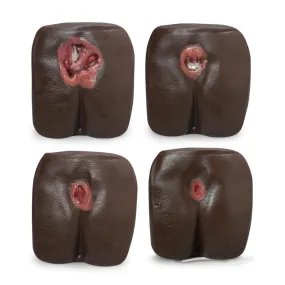 Pressure Ulcer-Bedsore Model, Dark
