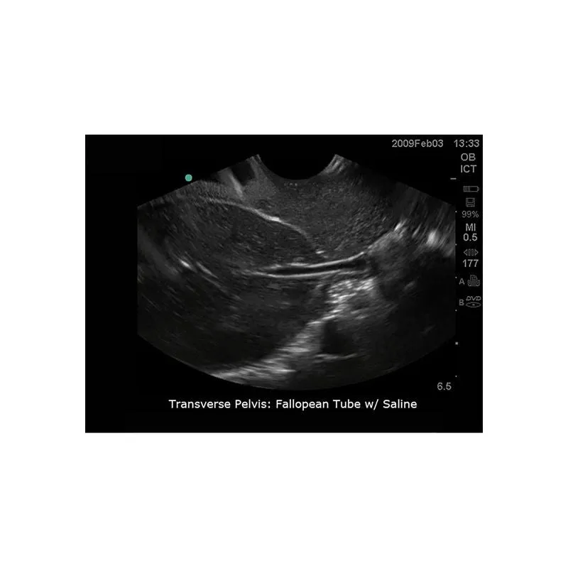 Sonohysterographay & Sonosalpingography Transvaginal Ultrasound Training Model