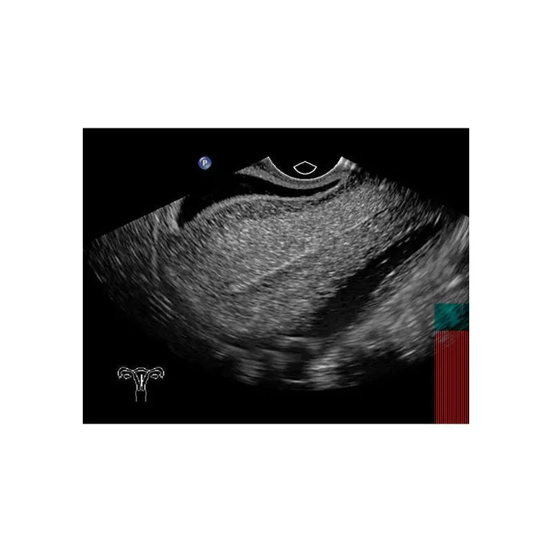 Sonohysterographay & Sonosalpingography Transvaginal Ultrasound Training Model
