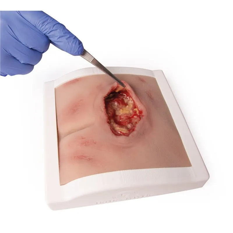 Wound Moulage Sacral Decubitus, Cleaned Including Stand