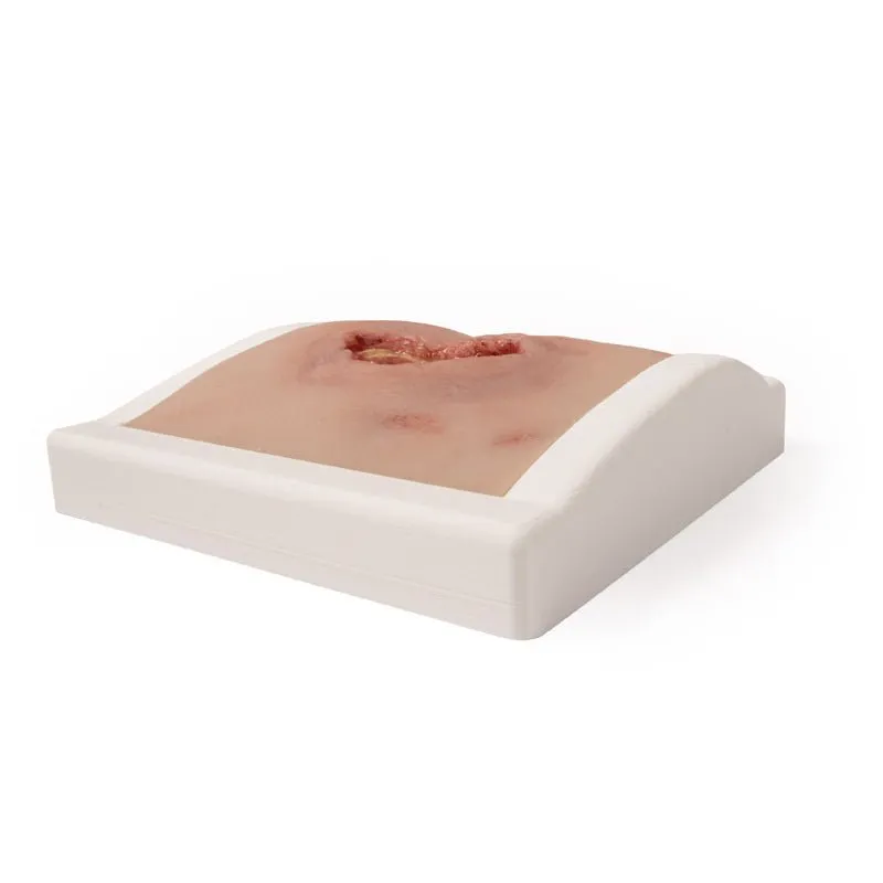 Wound Moulage Sacral Decubitus, Cleaned Including Stand