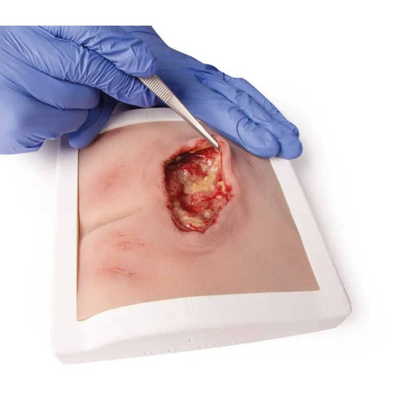 Wound Moulage Sacral Decubitus, Cleaned Including Stand