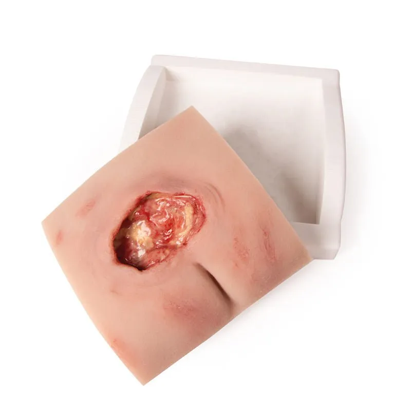 Wound Moulage Sacral Decubitus, Cleaned Including Stand