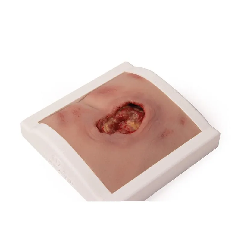 Wound Moulage Sacral Decubitus, Cleaned Including Stand