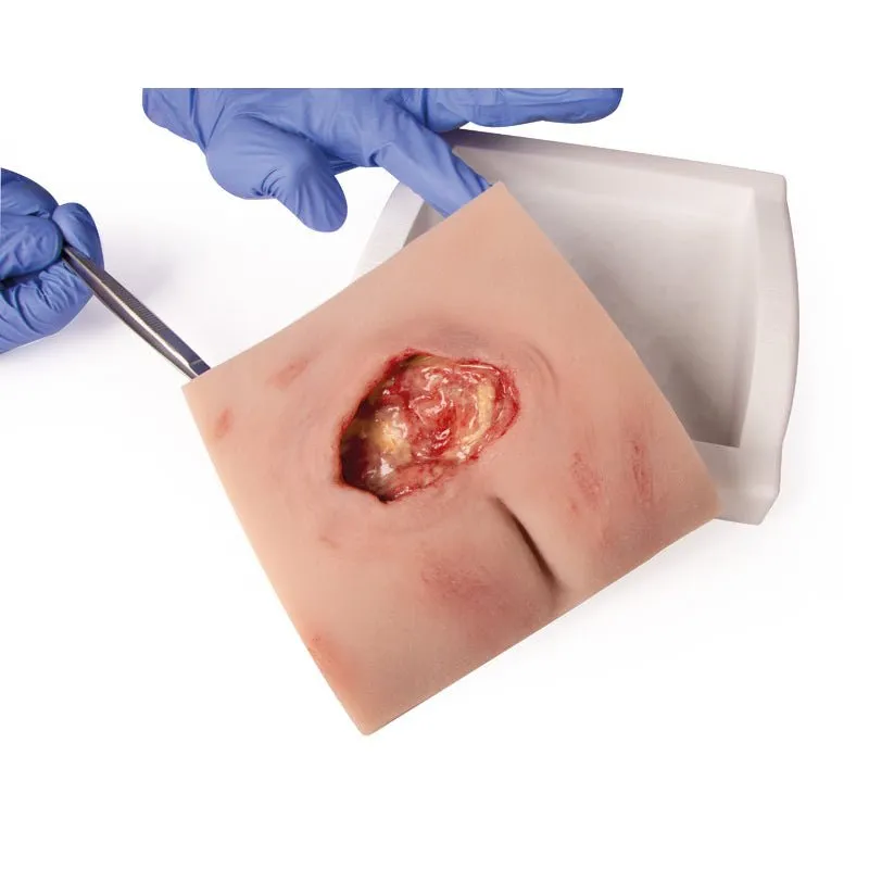 Wound Moulage Sacral Decubitus, Cleaned Including Stand