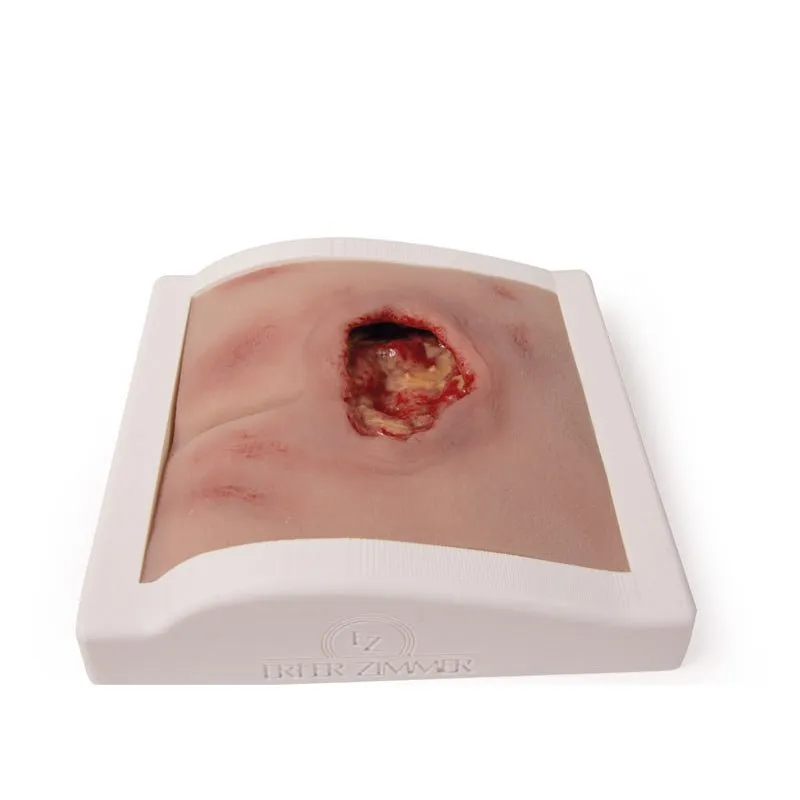 Wound Moulage Sacral Decubitus, Cleaned Including Stand