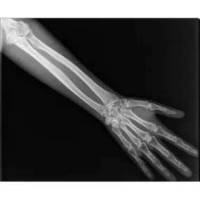 X-Ray Lower Arm Phantom, opaque