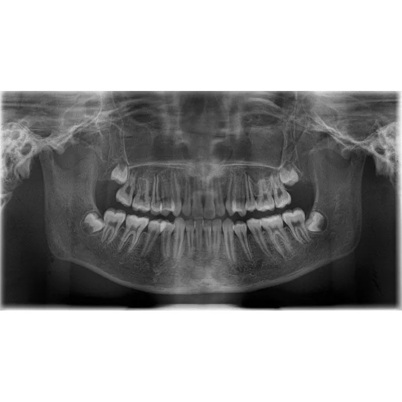 X-Ray Phantom Head With Cervical Vertebrae, Transparent
