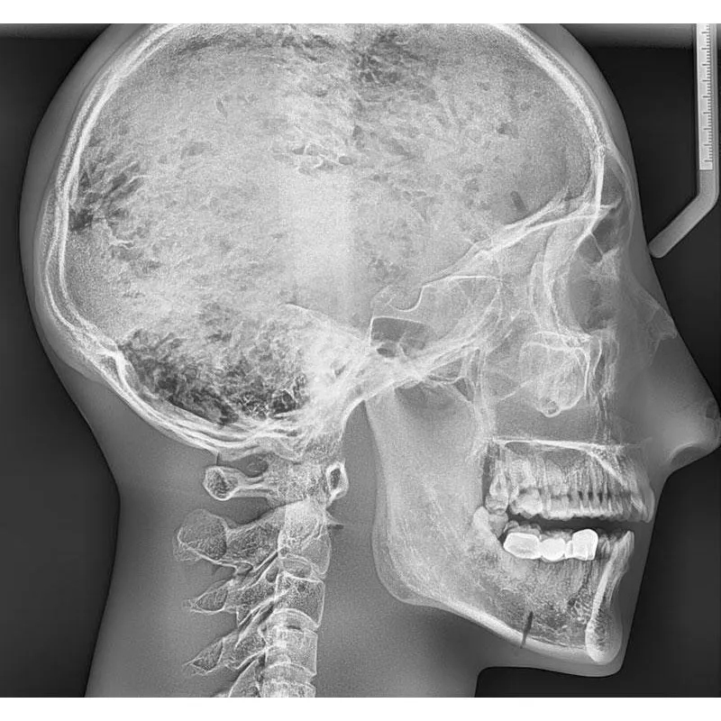X-Ray Phantom Head With Cervical Vertebrae, Transparent